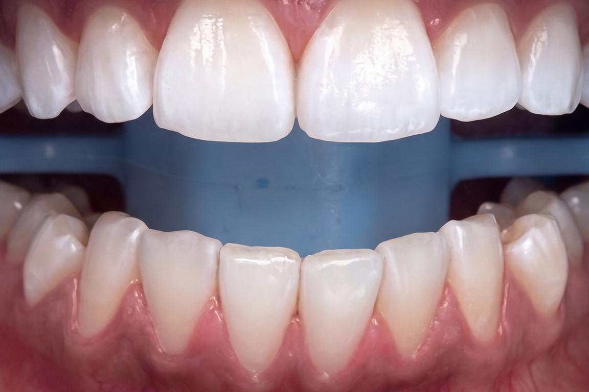 Le m&ecirc;me sourire apr&egrave;s le blanchiment dentaire professionnel